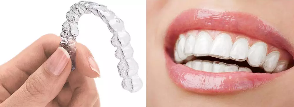 ordp Invisalign-clear-braces img2