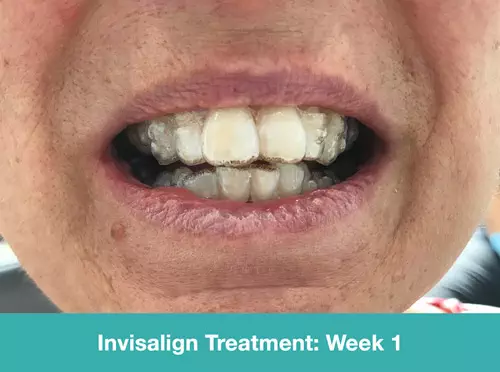 ordp Invisalign-Treatment-Week-1