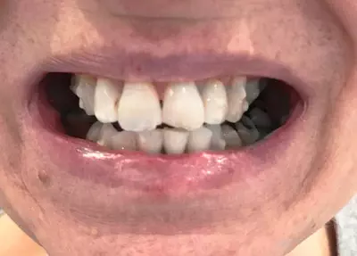 ordp Invisalign-Treatment-Week-12