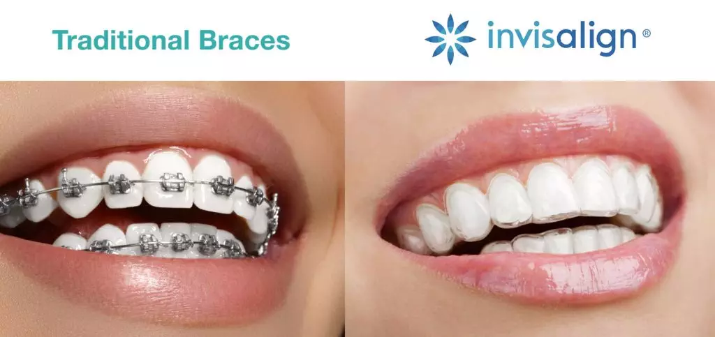 ordp invisalign-vs-metal-braces-img2-1024x483