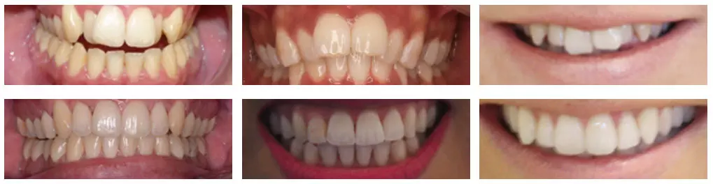 ordp invisalign-results
