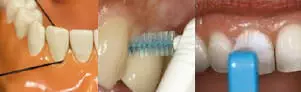 ordp flossing-to-stop-peridontal-disease