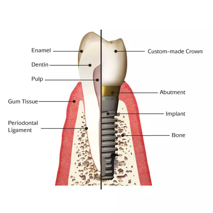 OakleyRoad-Dental-Pract-Implants