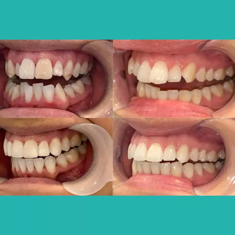 ordp-invisalign-img1-v1-1024x6401